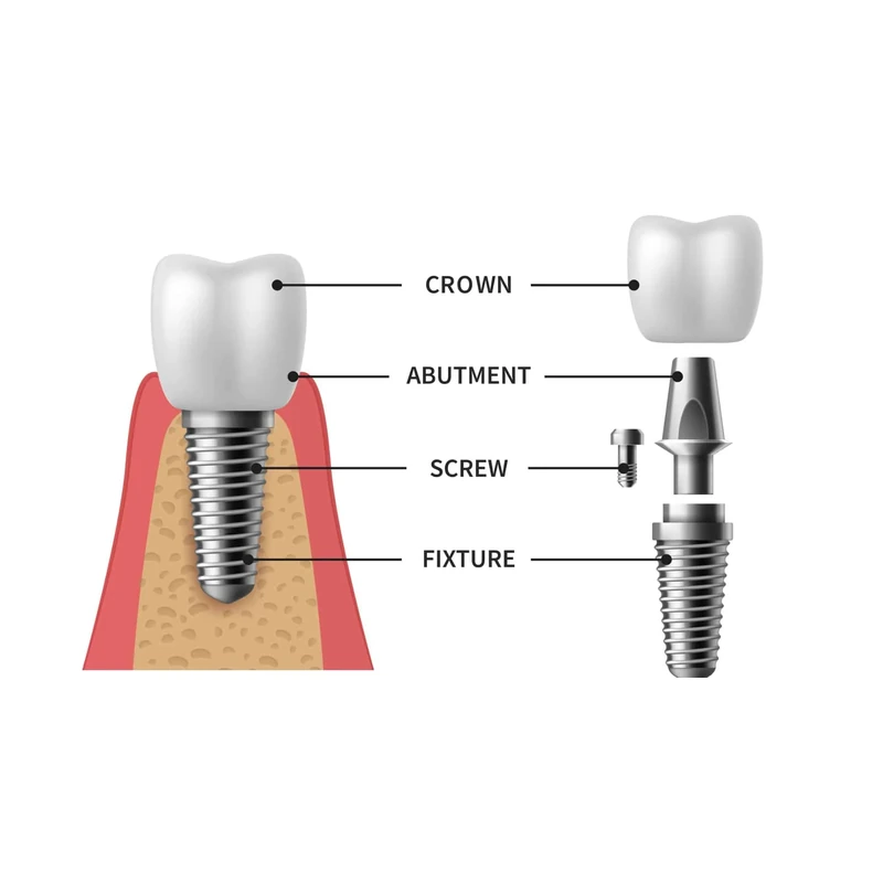 Abutment - ابتمت